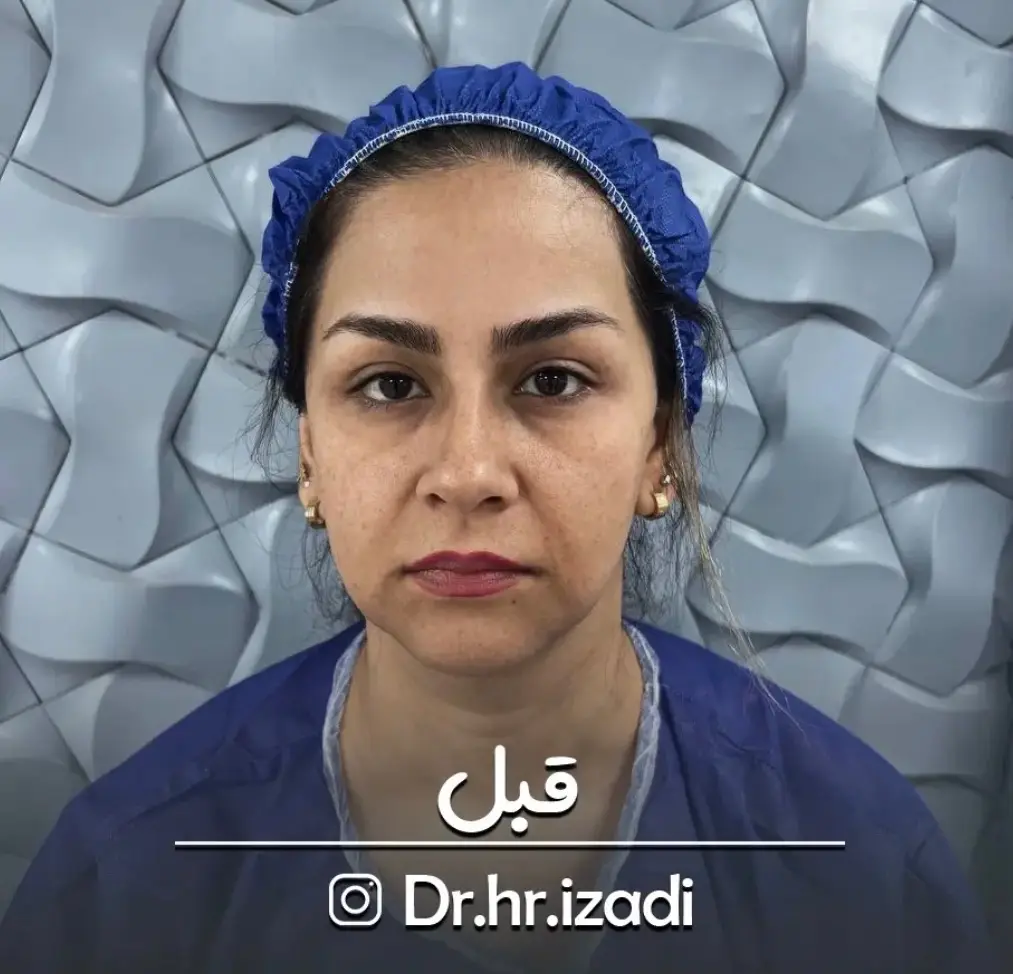 طراحی و کاشت ابرو — قبل