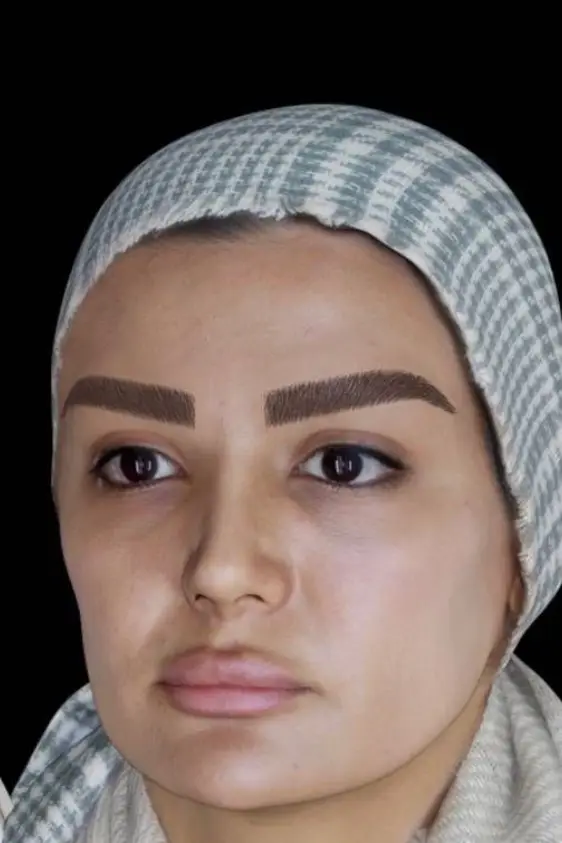 کاشت ابرو طبیعی — بعد