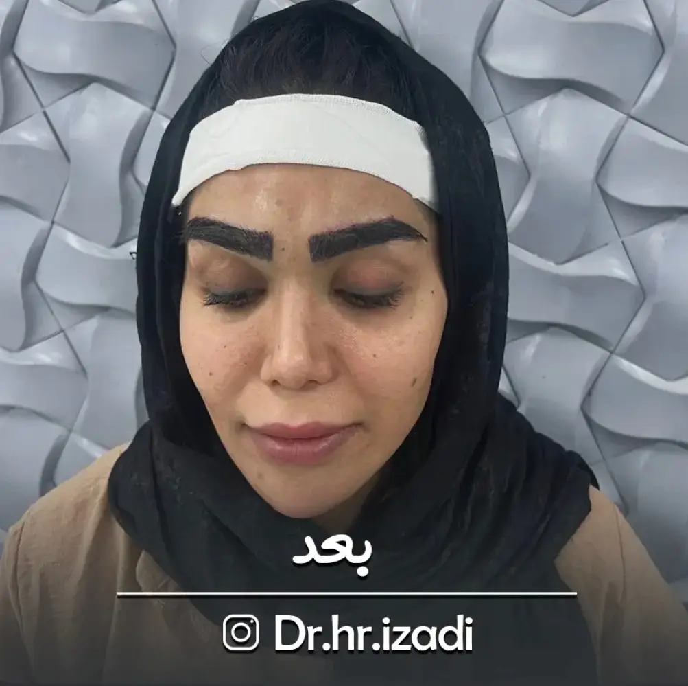 ترمیم ابرو — بعد
